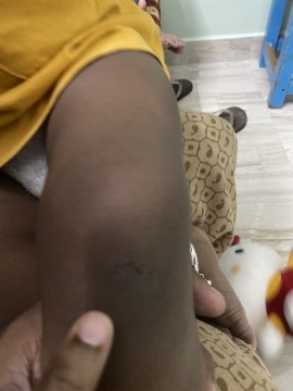 My First Wound